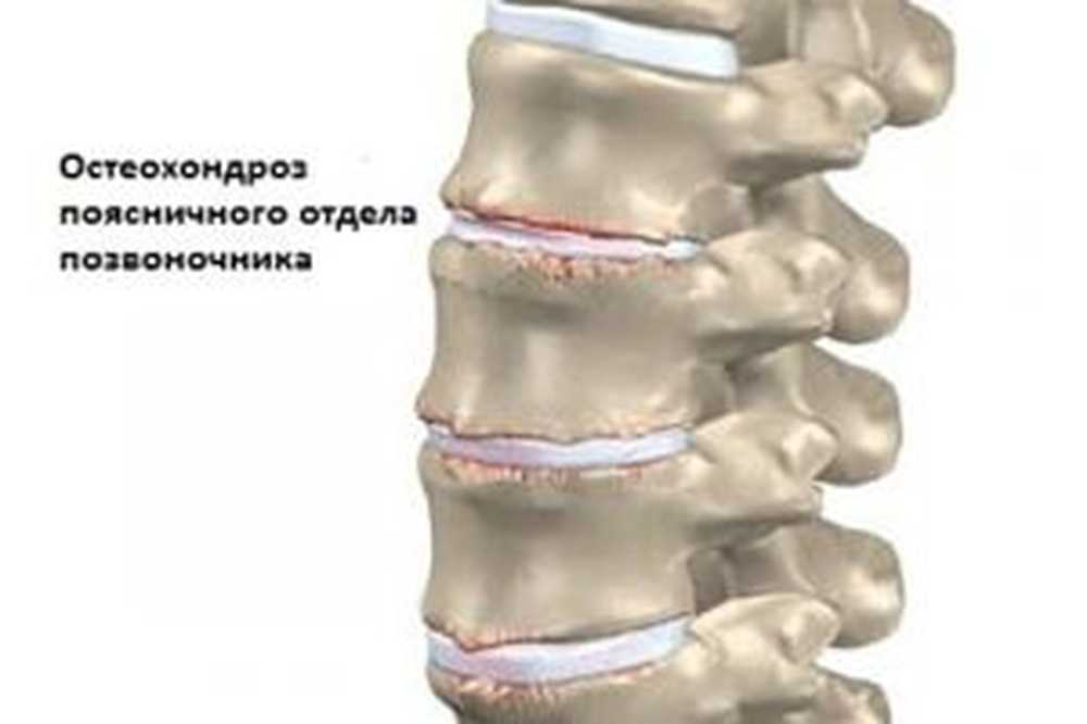 Картина спондилеза. Межпозвонковый остеохондроз поясничного отдела. Спондилёз поясничного отдела позвоночника что это такое. Спондилез пояснично-крестцового отдела позвоночника. Остеохондроз l1-l3 1 степень.