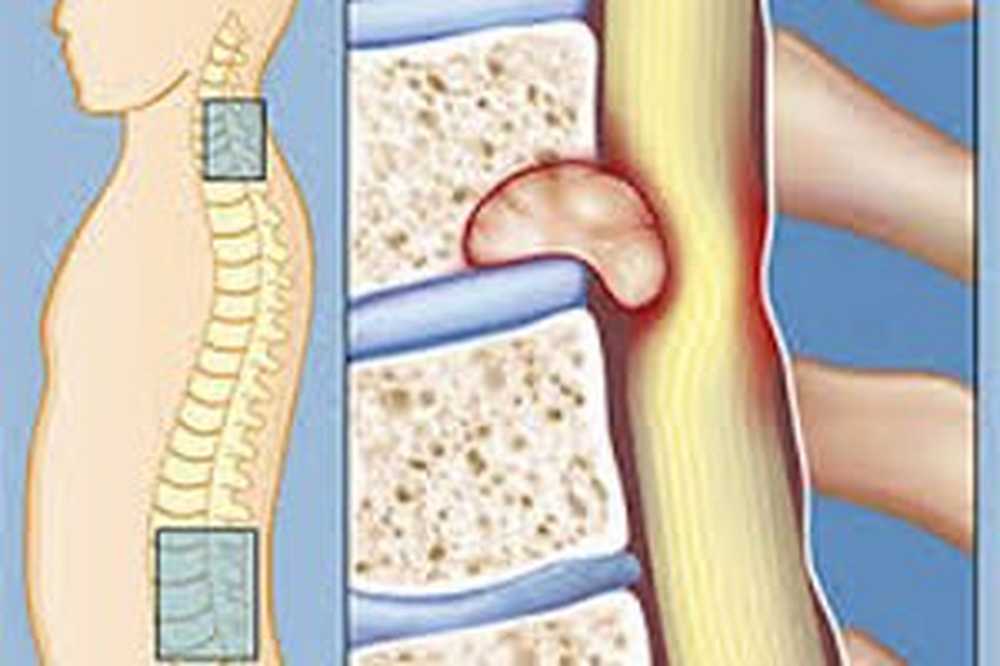 симптомы костного мозга