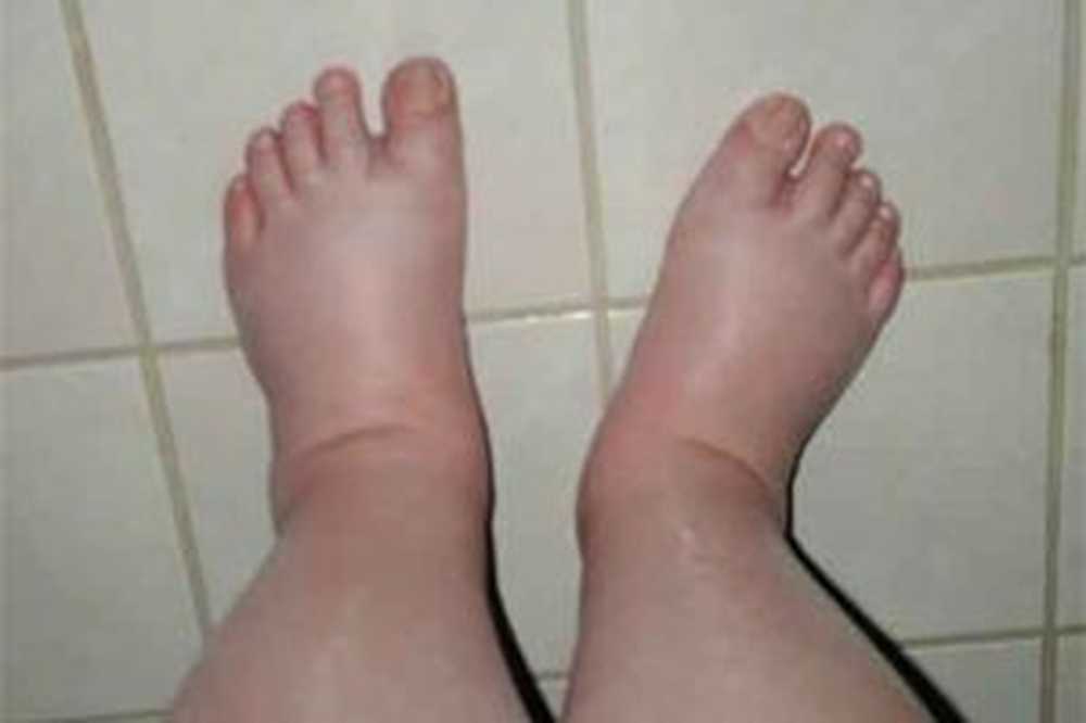 Почему у беременных отеки ног. Пастозность голеней и стоп что это.