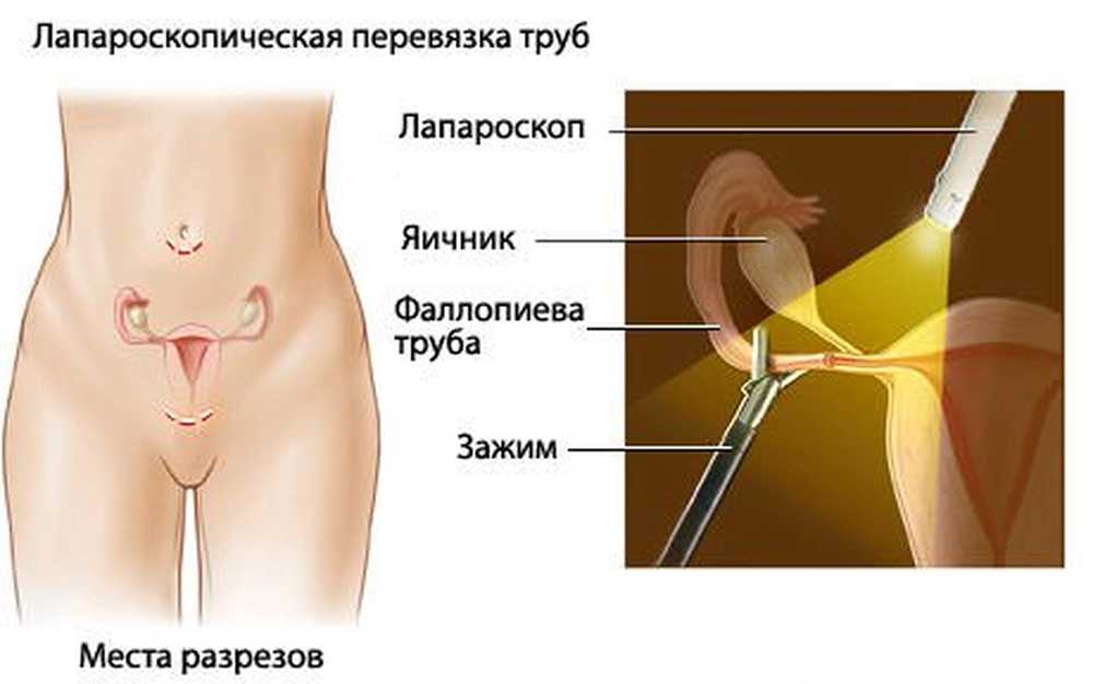 Перевязать трубы отзывы