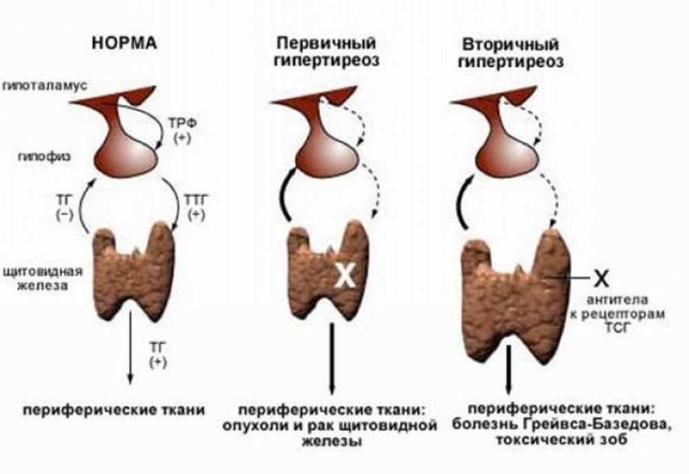 Гипотиреоз степени