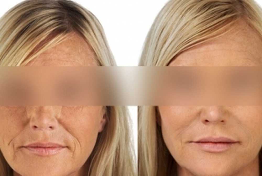 биоармирование лица отзывы. подтяжка бровей и средней третей лица. биоармирование лица отзывы. биоармирование носогубных складок. биоармирование векторный лифтинг.