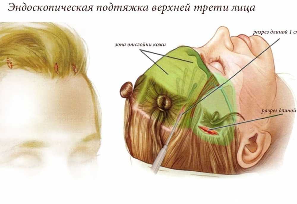 Подтяжка Лба И Бровей Фото