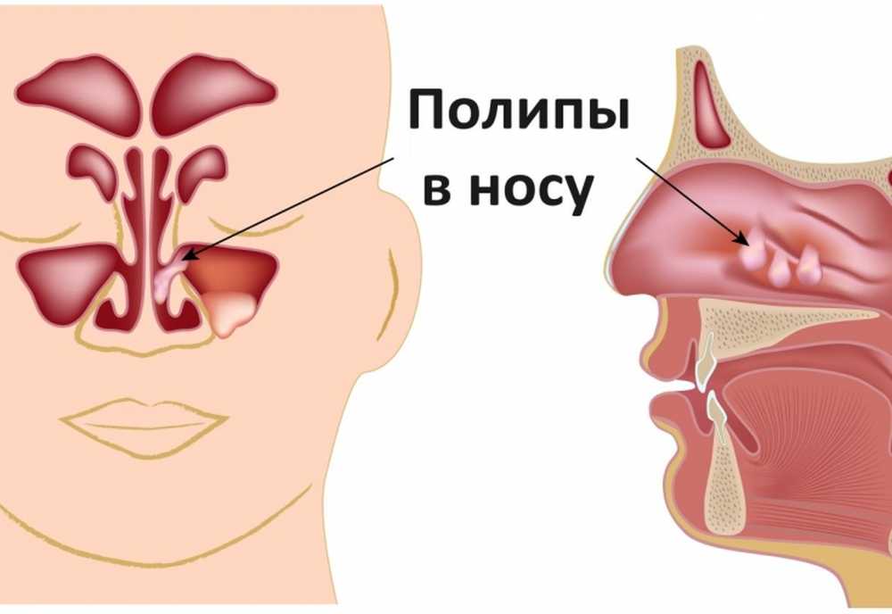 Нос полностью заложен. Полипозный риносинусит.