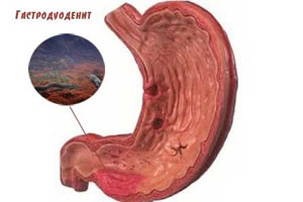 Тотальный желудка. Катаральный гастродуоденит. Хронический поверхностный гастродуоденит. Эзофагеальный гастродуоденит.
