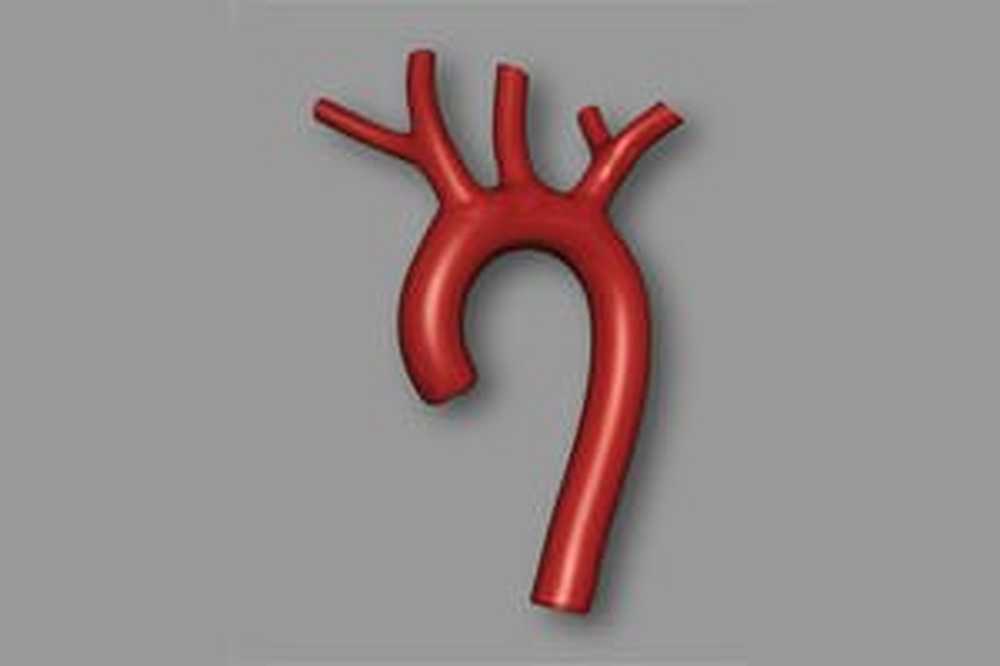 эндоваскулярное стентирование аорты. тромбоз бифуркации аорты. аорта в теле человека. стент графт аневризма брюшной аорты. сегменты аорты.