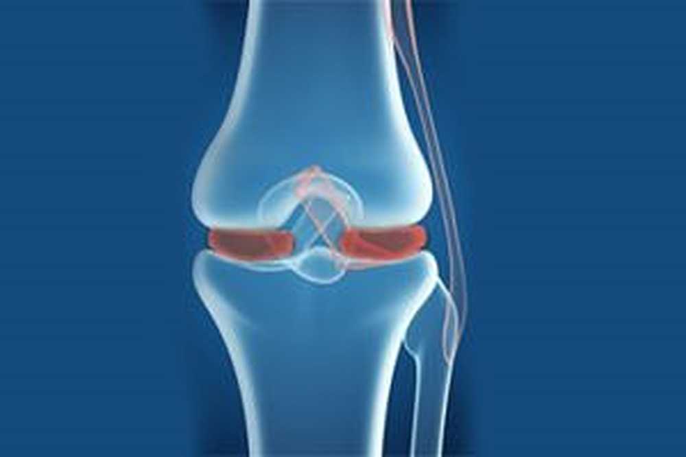 Повреждение менисков левого коленного сустава. Воспаление сустава мениск. Мениск коленного сустава. Внутренний менисцит коленного сустава.