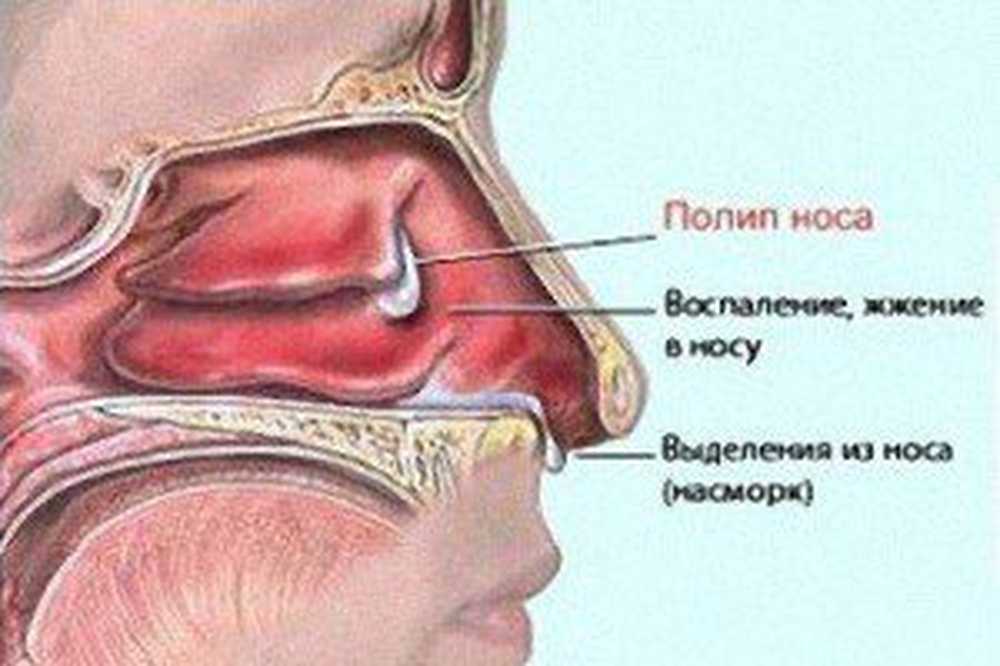 Можно делать операция насморке