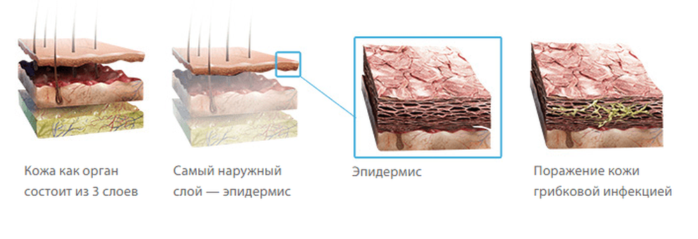 Грибок Кожи Разновидности Фото И Названия