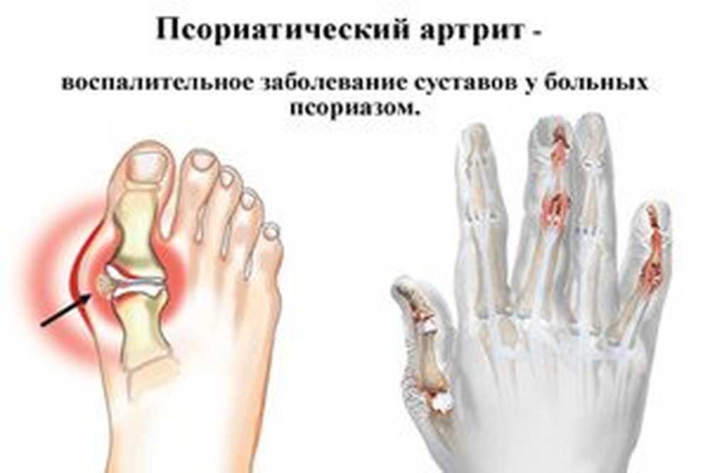Воспаление суставов заболевание. Псориатический артрит мкб 10. Псориатический артрит это спондилоартрит. Ревматоидный псориатический артрит.