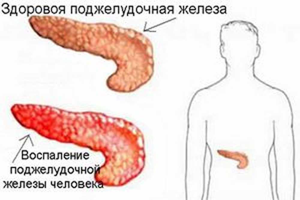 Поджелудочная железа хроническое заболевание