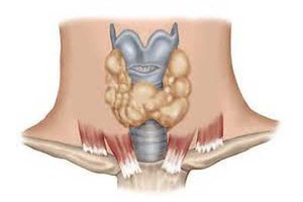 Диффузно-узловой зоб щитовидной железы 3 степени. Диффузно узловая щитовидная железа. Диффузного эутиреоидного зоба. Диффузно узловая щитовидная железа. Разрастание лимфоидной ткани щитовидной железы.