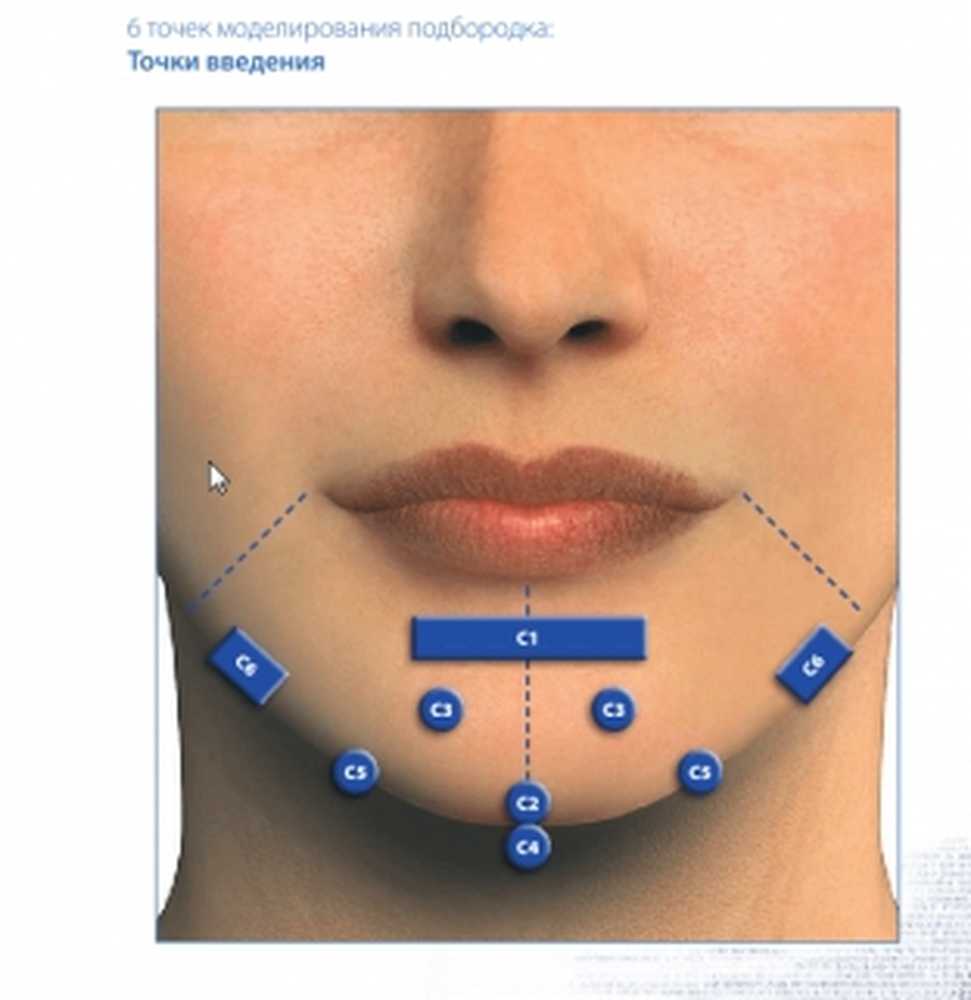 Точка колоть. Точки введения филлеров на лице. Точки введения ботулотоксина в подбородок. Ботокс в подбородок точки. Точки введения ботокса в подбородок.