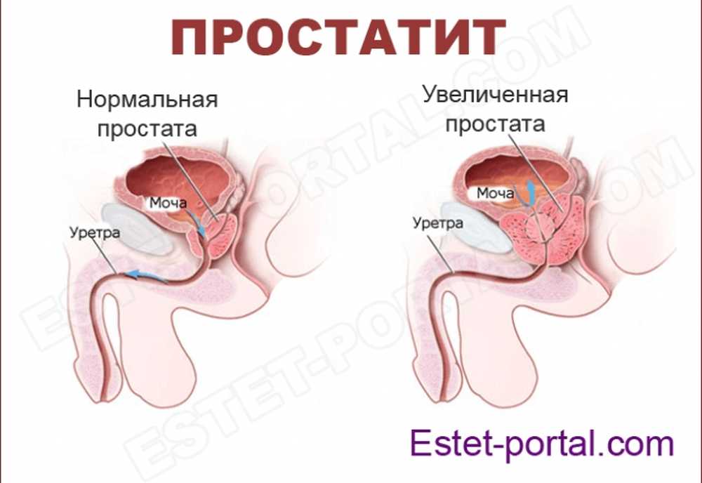 Простата у мужчин симптомы. Симптомы хронического простатита. Раковые заболевания простаты. Простата нормальная и воспаленная. Простата у мужчин что это простыми словами.