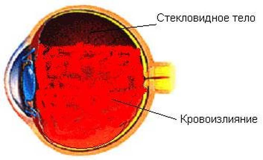 Стекловидное Тело Картинки