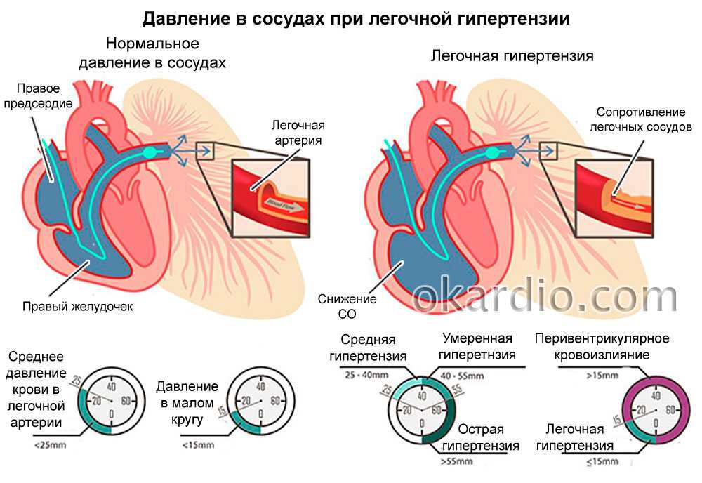 Давление крови в правом предсердии. Первичная легочная гипертензия симптомы. Синдром легочной гипертензии патогенез. Легочная артериальная гипертензия симптомы. Повышение давления в легочной артерии.