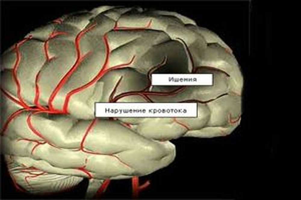 Хроническая ишемия мозга 1. Ишемическая болезнь мозга. Ишемия сосудов головного мозга. Ишемия головного мозга симптомы. Хроническая ишемия мозга симптомы.