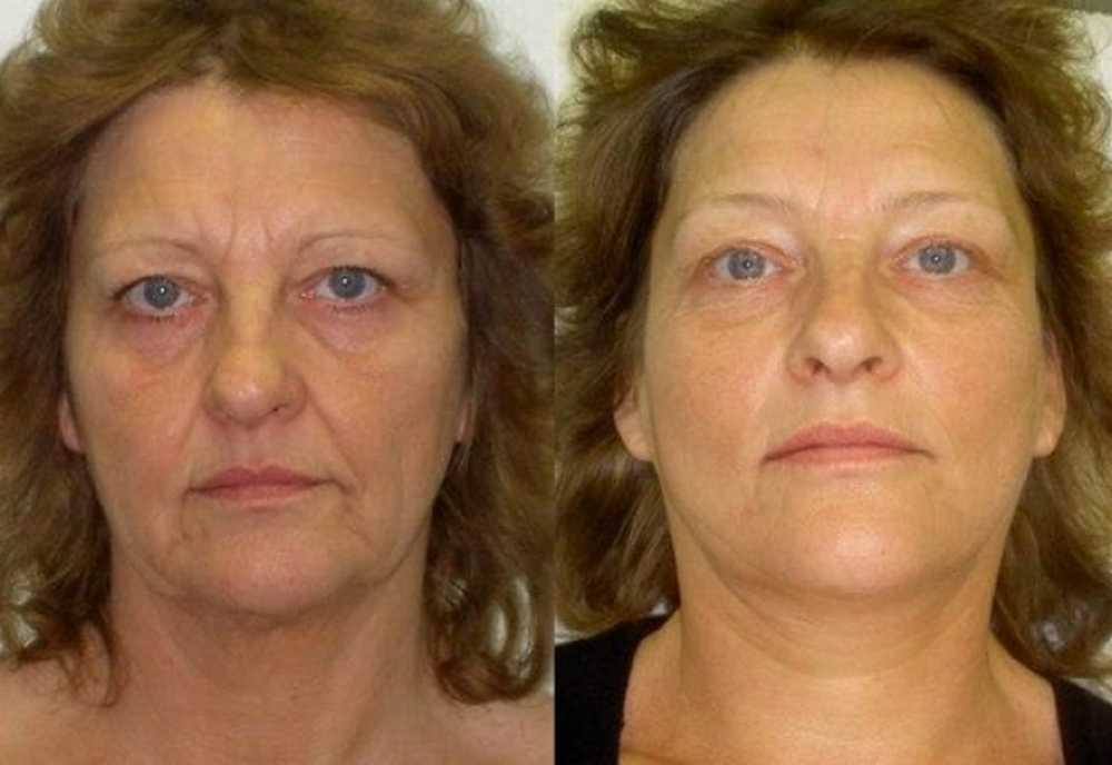 Лазерное омоложение эффект. Омоложение лица до и после. Фотоомоложение до и после. Фотоомоложение лица морщины. Фотолечение лица до и после.