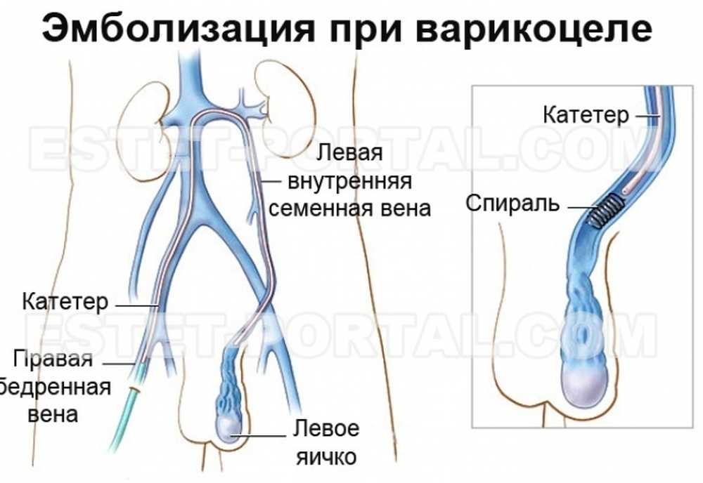 Расширение вен канатика