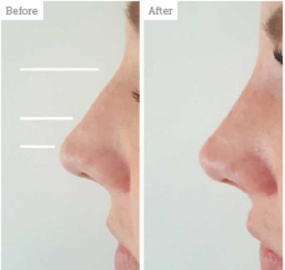 Бродовский максим борисович септопластика. Глубокие ноздри. Глубокие ноздри. Септопластика лор операция. Безоперационная пластика носа.