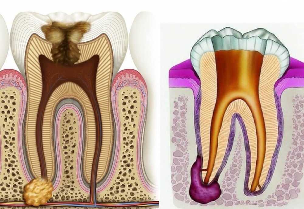 Пульпит и периодонтит: в чем разница, причины появления, лечение и его цена