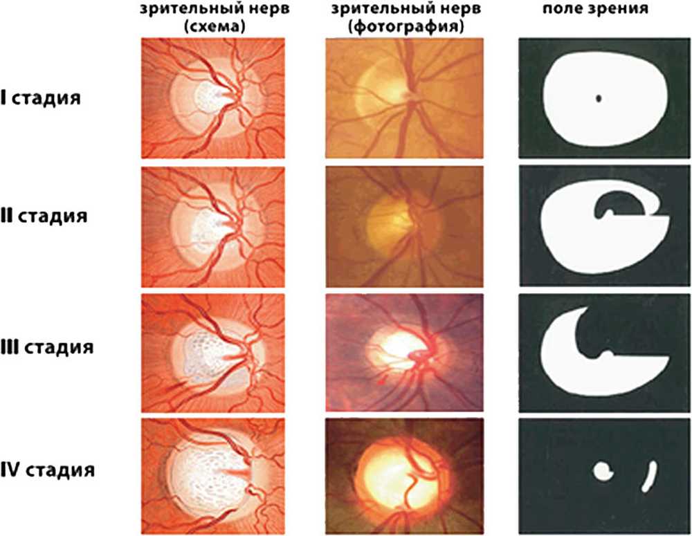 Можно вернуть зрение при глаукоме. Атрофия зрительного нерва Лебера. Атрофия зрительного нерва классификация. Атрофия зрительного нерва Лебера этиология. Открытоугольная глаукома глазное дно.
