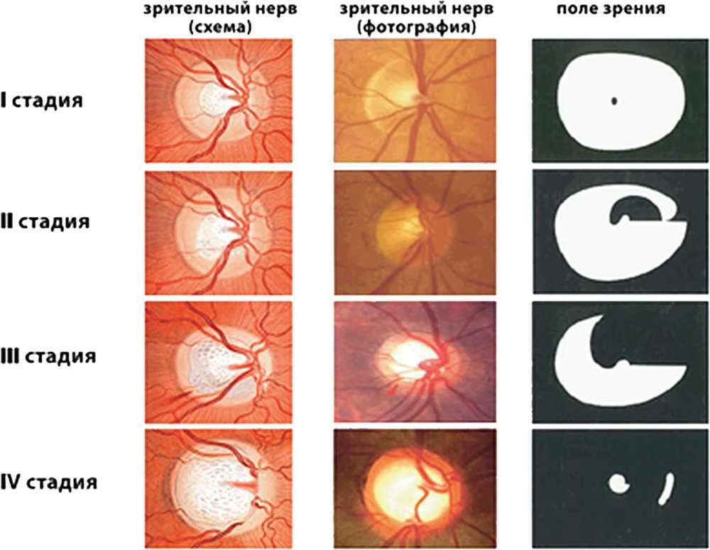 Что нельзя делать при глаукоме. Атрофия зрительного нерва Лебера. Атрофия зрительного нерва классификация. Атрофия зрительного нерва Лебера этиология. Открытоугольная глаукома глазное дно.
