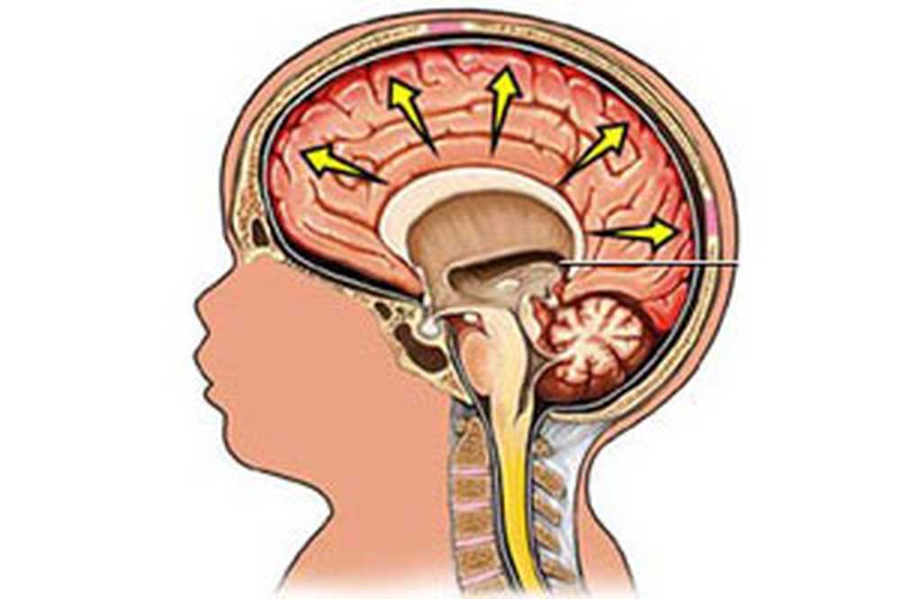Шунт головного мозга. Нарушение оттока спинномозговой жидкости. Ликвор в головном мозге при гидроцефалии. Дренаж ликвора головного мозга. Шунтирование ликвора головного мозга.
