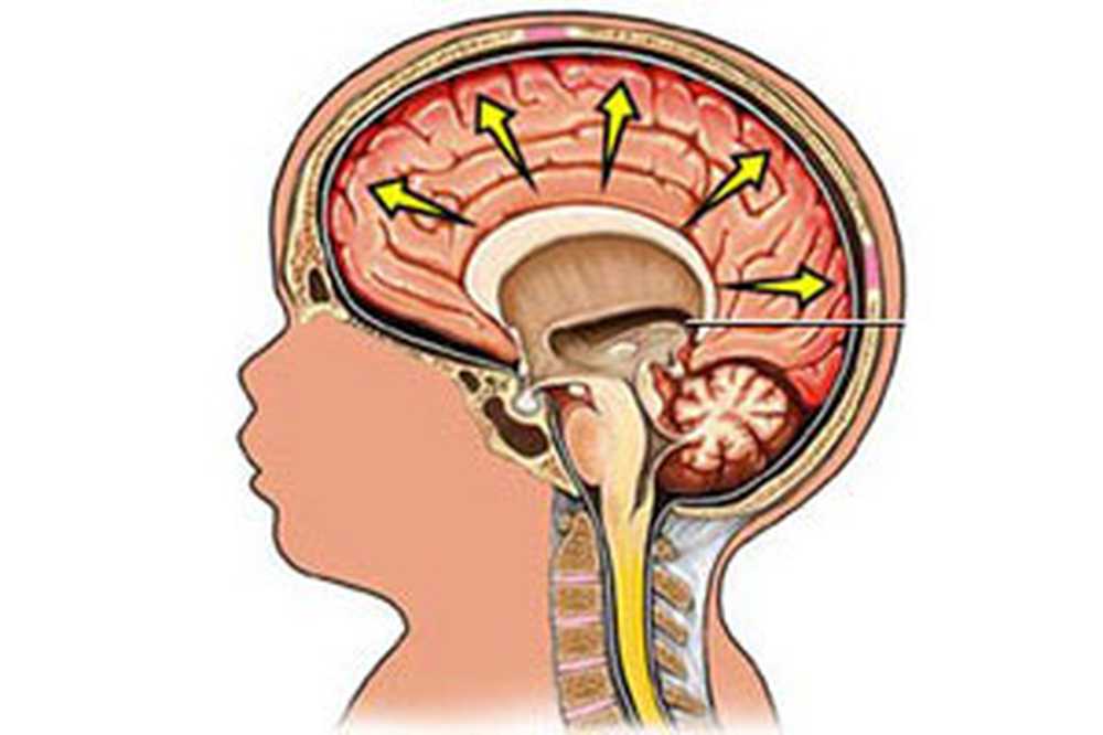 Гидроцефалия шунтирование мозга