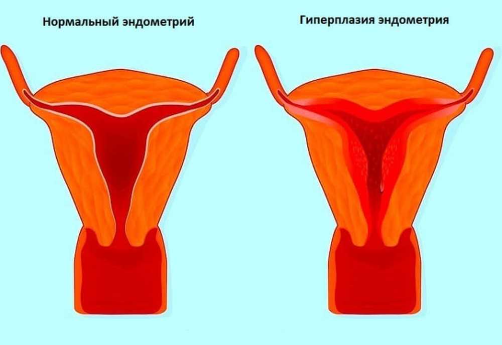 гиперплазия миометрия. гиперплазия эндометрия. остановка кровотечения при гипотонии матки. эндометрий матки кровотечение. эндометрий матки кровотечение.