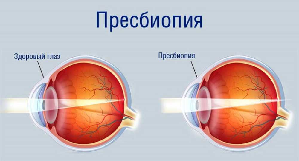 Почему у людей пожилого возраста развивается дальнозоркость. Старческая дальнозоркость (что это такое? Методы коррекции). Пресбиопия (возрастная дальнозоркость). Дальнозоркость и близорукость строение глаза. Пресбиопия глаз.