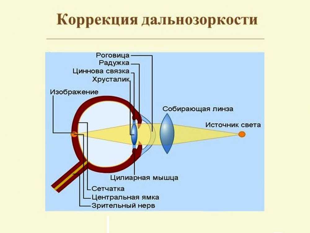 Причина дальнозоркости изображение формируется ближе к сетчатке