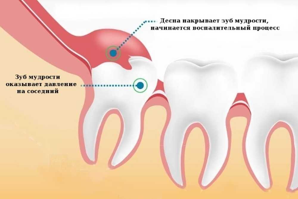 Зуб мудрости растет снизу. Зуб мудрости отдает в другие зубы. Зуб мудрости отдает в другие зубы. Прорезается зуб мудрости. Где растет зуб мудрости.