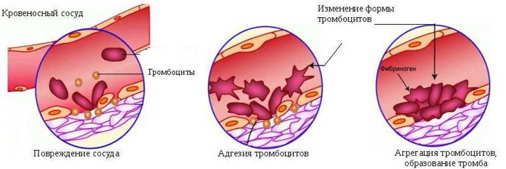 Тромбоциты при кровотечении. Стадии образования тромба схема. Механизм образования тромба схема. Тромбоциты образование тромба. Этапы образования тромба в кровеносном сосуде.