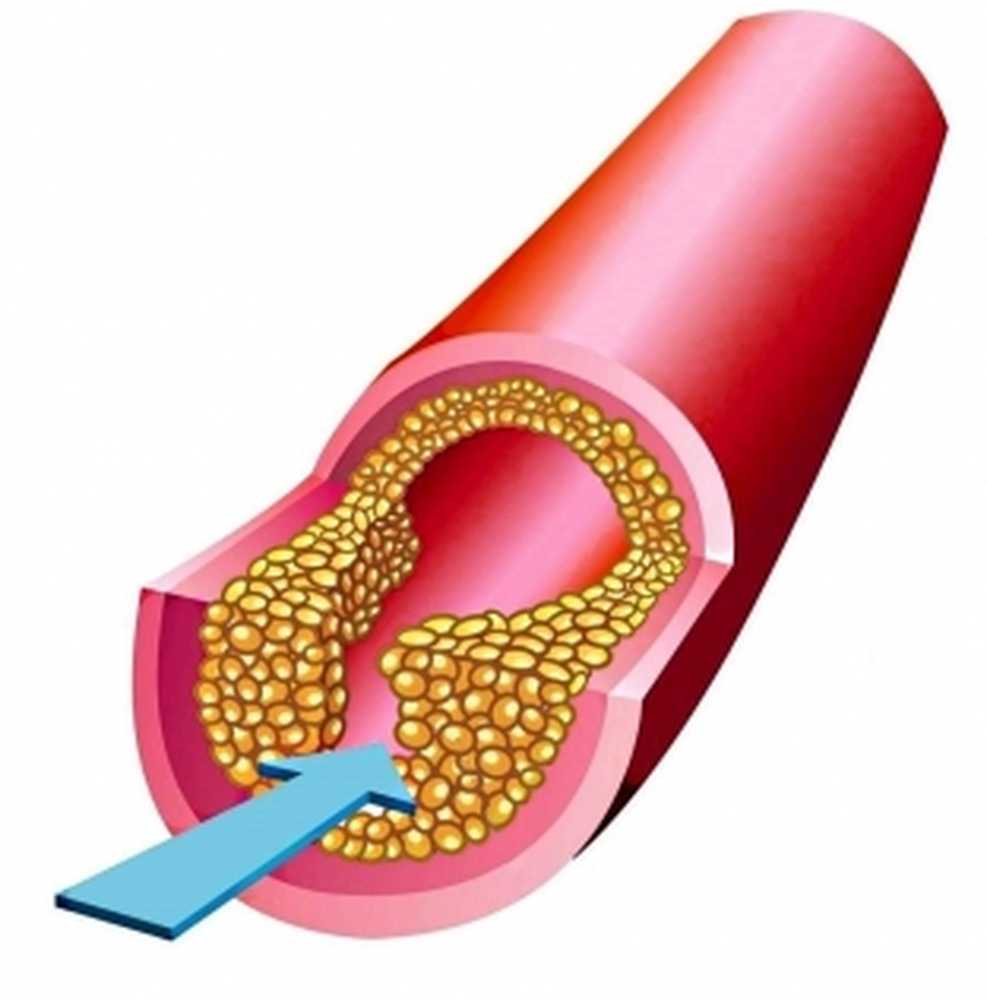 Чем чистить холестериновые бляшки