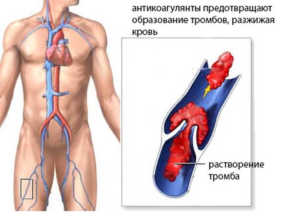 Тромбоз кровотечение