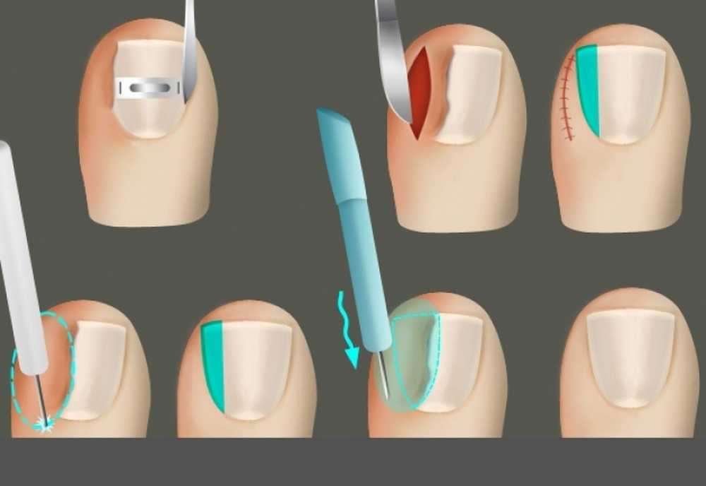 Врезаются ногти что делать. Операция вросшогоногтя. Хирургический вырезание вросшего ногтя.