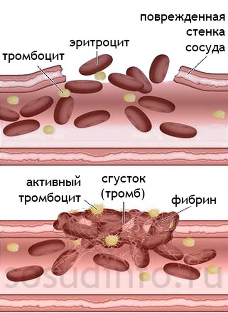 Образование тромба схема