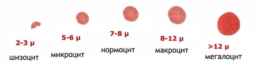 Средний диаметр эритроцитов. Эритроциты при макроцитарной анемии. Классификация анемий по форме и размеру эритроцитов. Размер эритроцита в норме. Измененные эритроциты в крови.