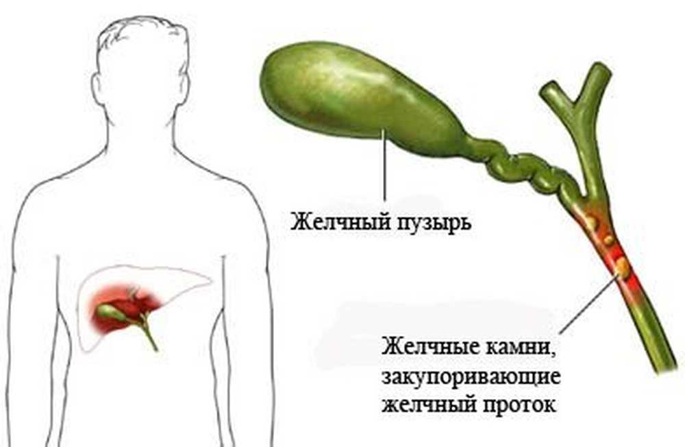 Холецистит картинки для презентации