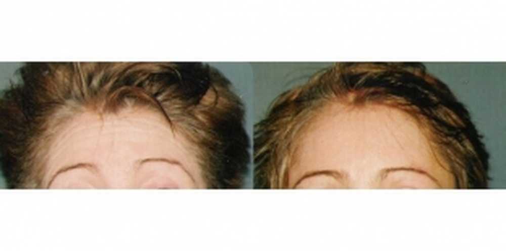 Тракционная алопеция у женщин. Послеродовая алопеция. Дарсонваль от выпадения волос. Могут ли выпадать волосы после наркоза. Выпадение волос до и после.