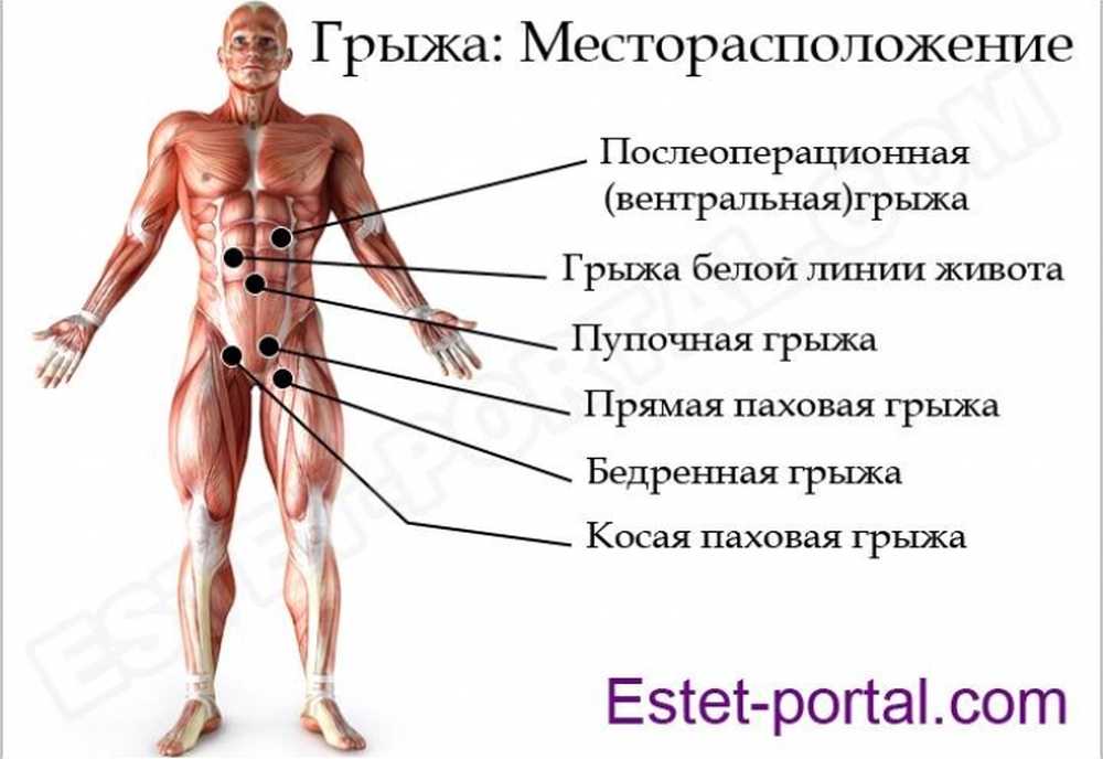 Грыжа слева внизу живота у женщин симптомы. Какие виды грыжи существует. Места возникновения грыж.