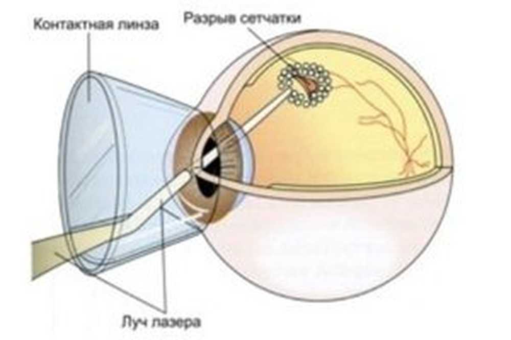 После укрепления сетчатки. Ограничительная лазеркоагуляция сетчатки глаза. Линза для лазерной коагуляции сетчатки. Периферическая лазеркоагуляция сетчатки глаза. Приваривание лазером отслоившейся сетчатки глаза.