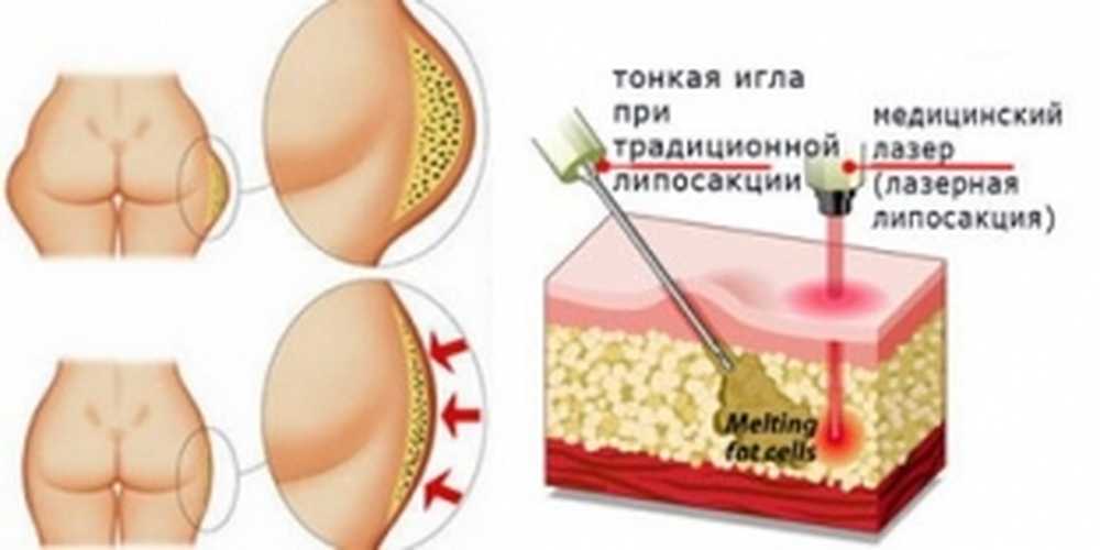 Липосакция Что Это Такое Фото