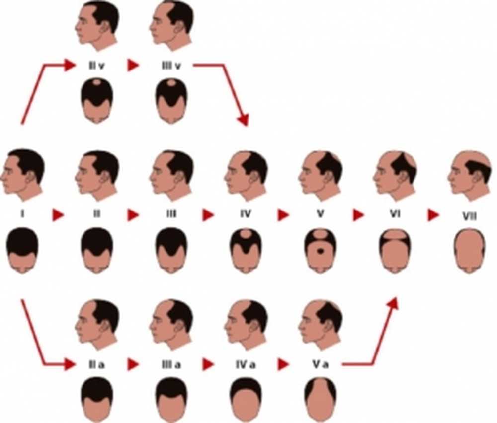 норвуд облысение. гамильтона норвуда. норвуд шкала облысения. норвуд облысение. классификация гамильтона норвуда.