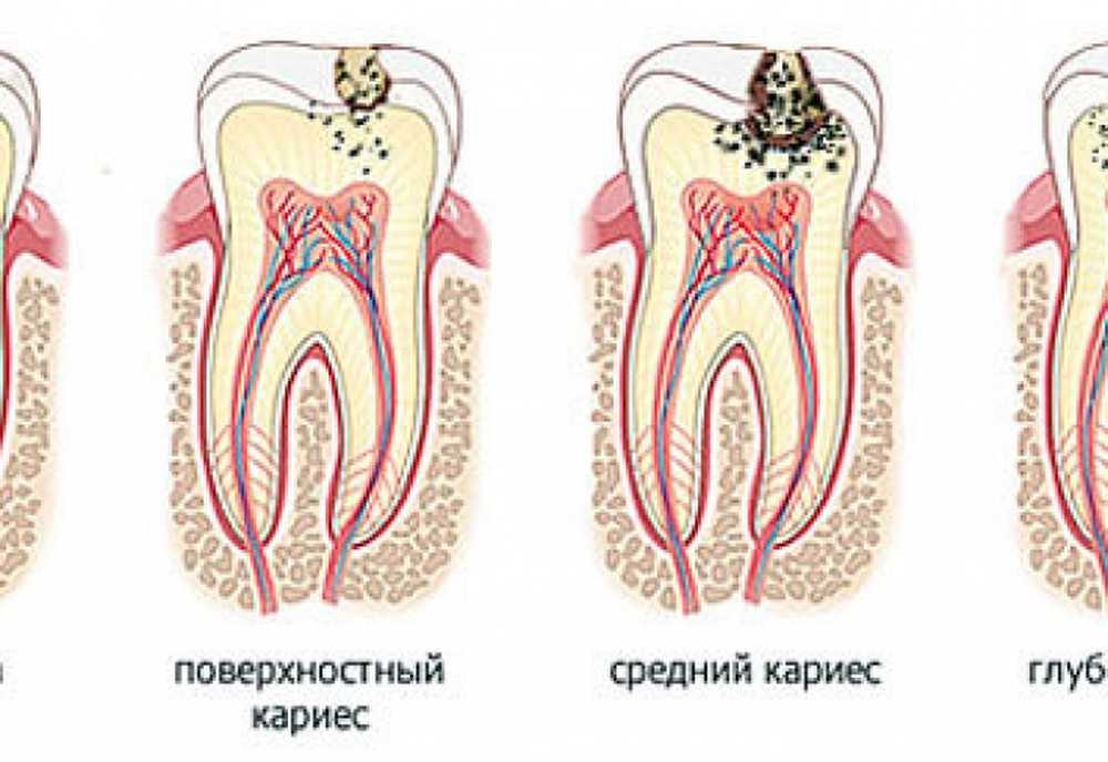 Кариеса Зубов Фото Лечение
