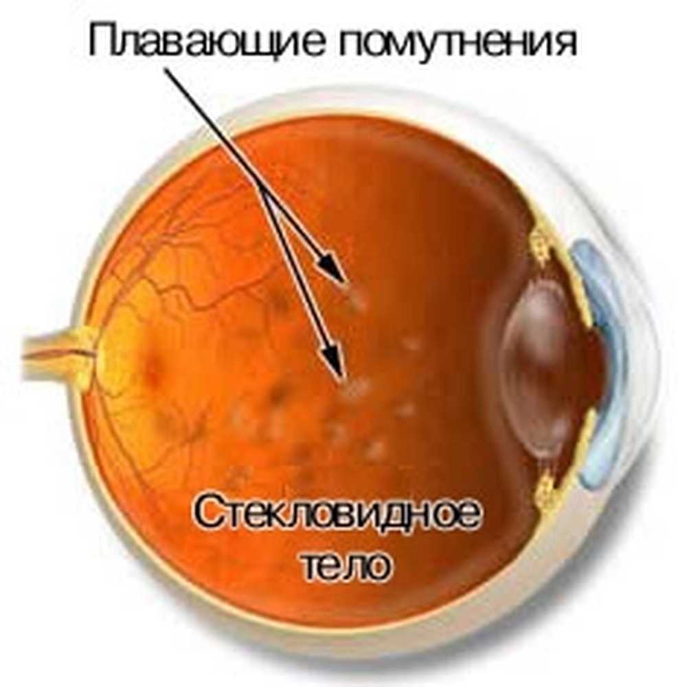 Мушки в глазах причина и лечение. Плавающие помутнения в стекловидном теле глаза что это. Помутнения стекловидного тела плавающие. Деструкция стекловидного тела. Дестркуция стекловидногт ела.