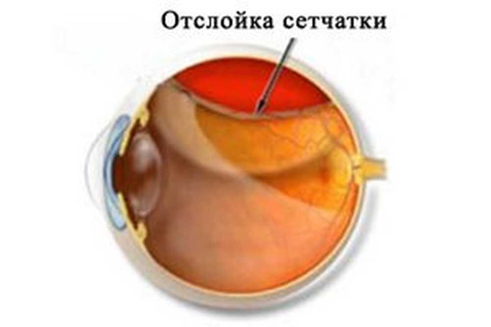 Фотографии ОТСЛОЙКА СЕТЧАТКИ СИМПТОМЫ И ЛЕЧЕНИЕ