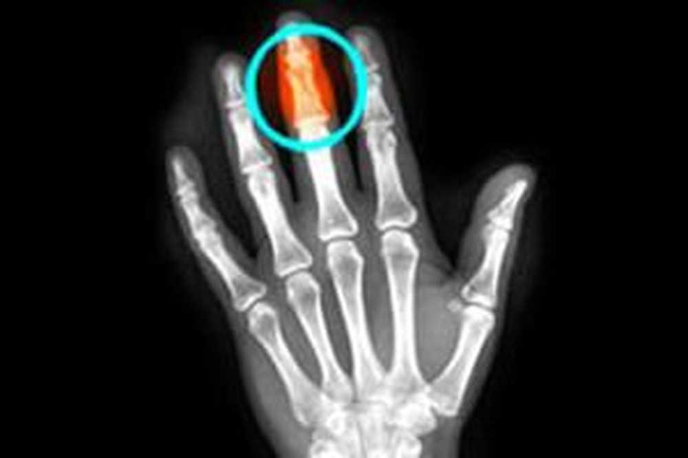 Трещина в кисти. Рентген перелома средней, фаланги мизинца руки. Перелом средней фаланги пальца на руке рентген. Рентген перелома пальца мизинца. Рентген перелома фаланги большого пальца руки.