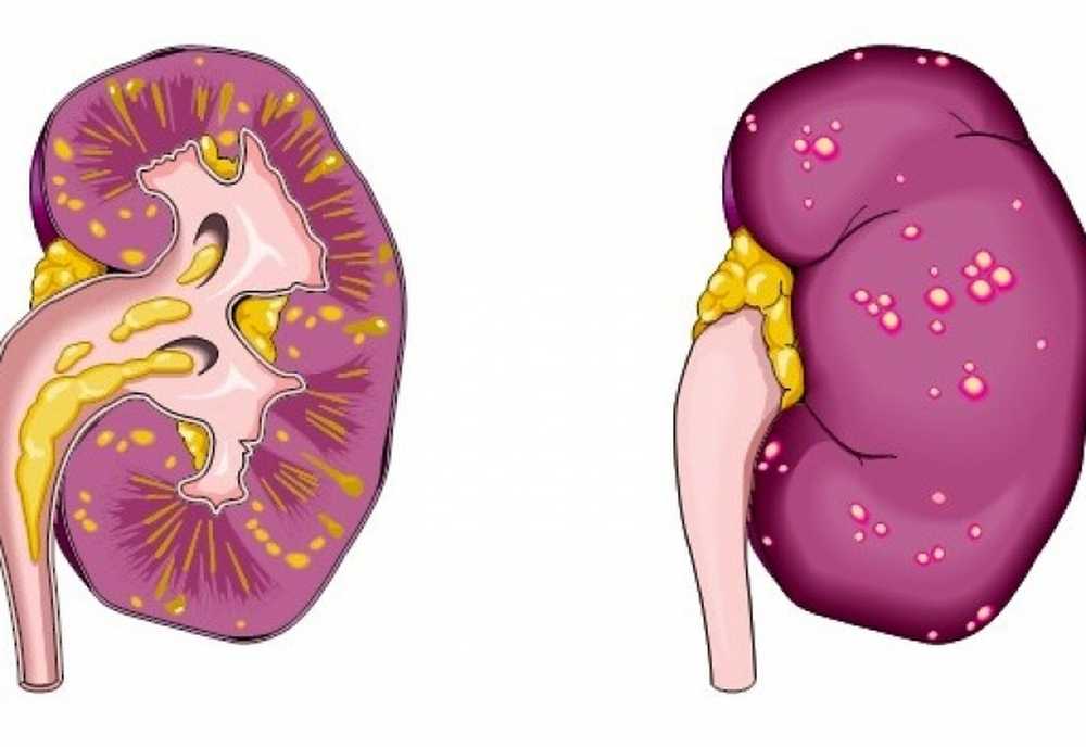 Почка после пиелонефрита